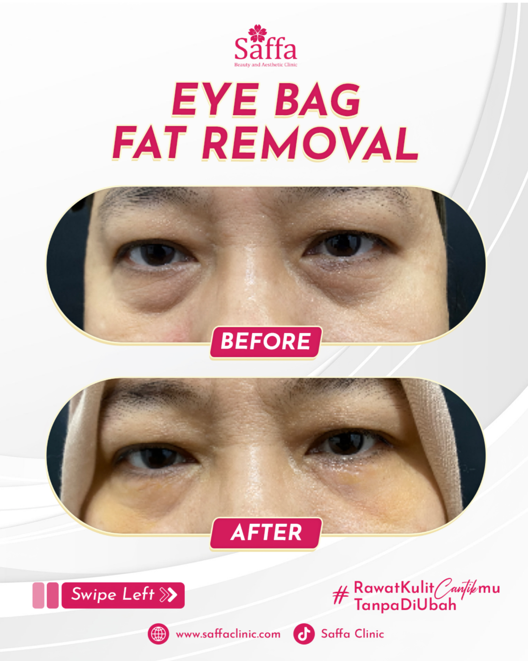 Before After